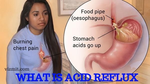 how to get rid of acid reflux
